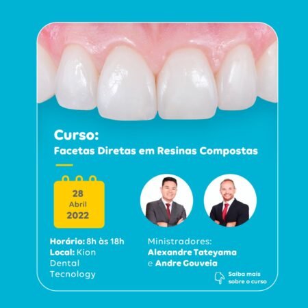 Facetas Diretas em Resina Composta - 28/04/2022